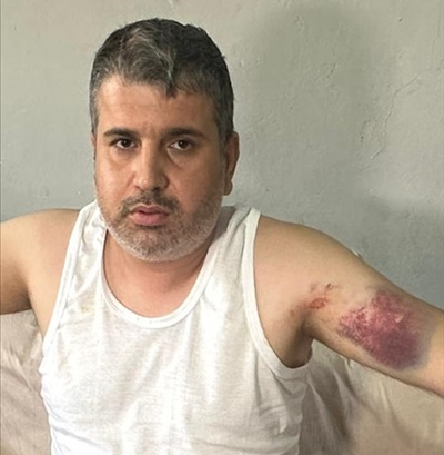 Adana'da dayısı tarafından beyzbol sopasıyla darbedilen kişi yaralandı